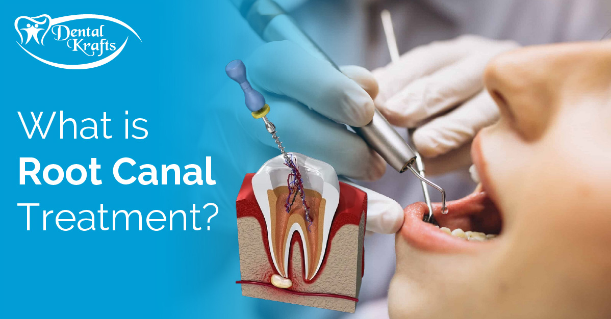 What is root canal treatment 