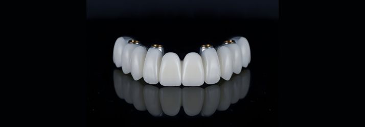 All-on-4 Dental Implants in Gurgaon