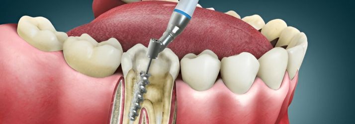 Root Canal Treatment Cost in Gurgaon