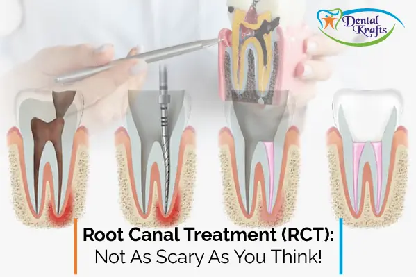 Root Canal Treatment