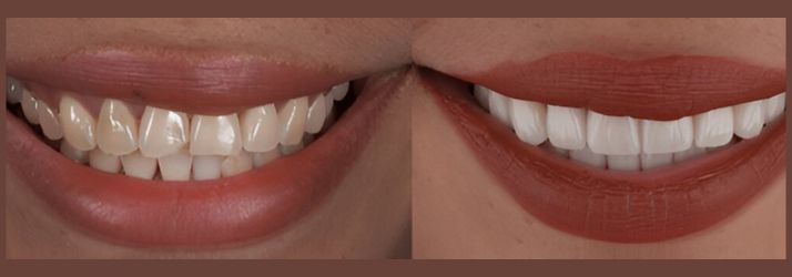 Smile Design Cost in Gurgaon