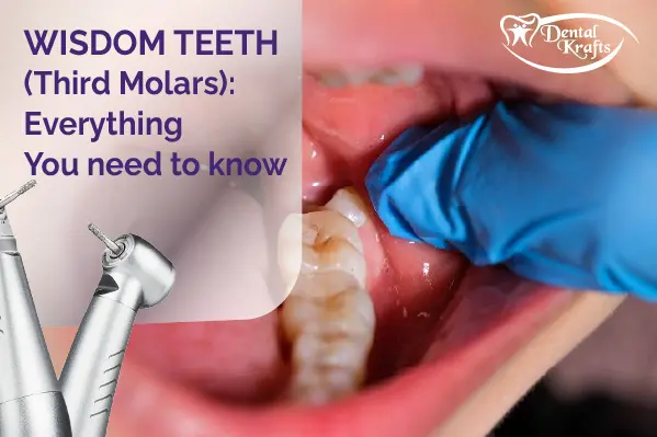 Wisdom Teeth (Third Molars)