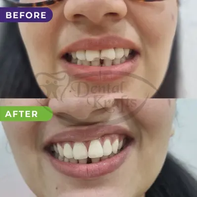 direct veneers treatment gurgaon
