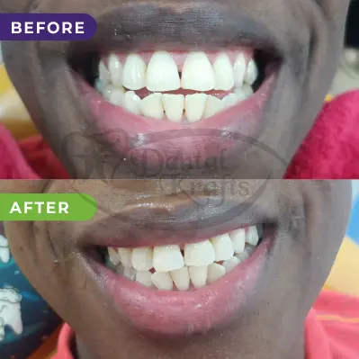 teeth whitening treatment gurgaon