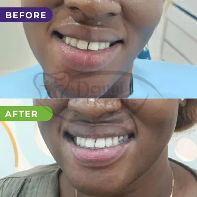 teeth whitening treatment gurgaon