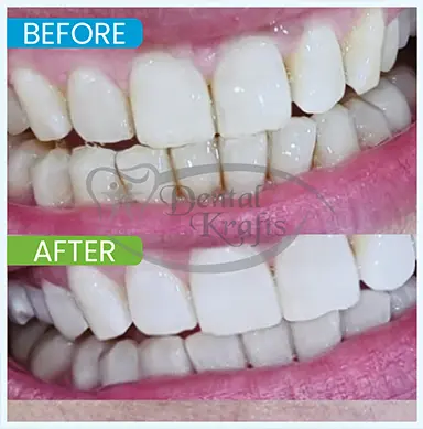 teeth whitening treatment gurgaon
