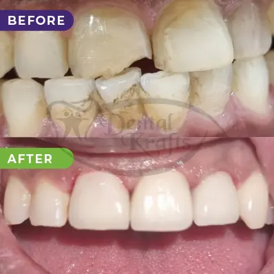 smile makeover treatment gurgaon