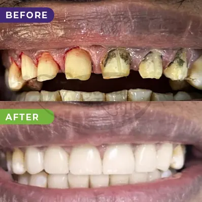 Smile makeover gurgaon