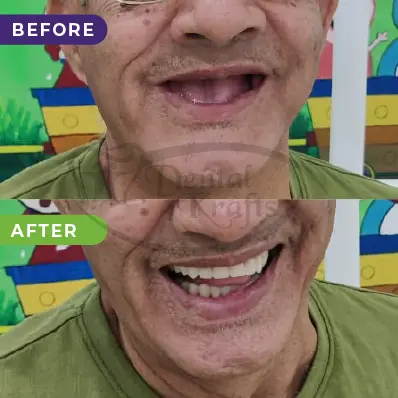 Dentures treatment gurgaon