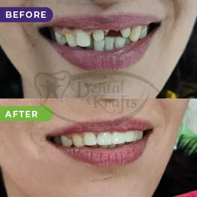 Front cap on teeth in gurgaon