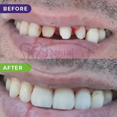 Crowns treatment gurgaon
