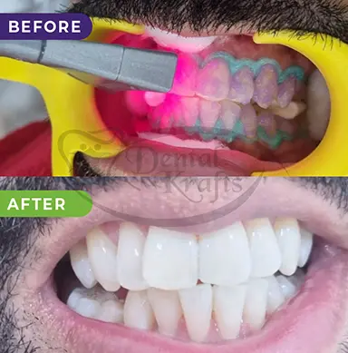 full mouth rehabilitation treatment gurgaon