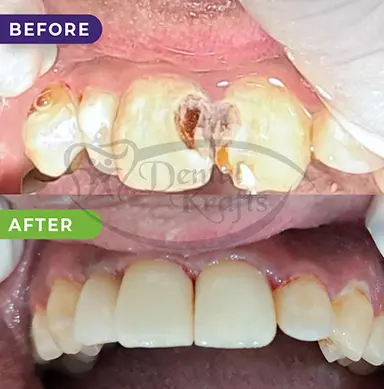 full mouth rehabilitation treatment gurgaon