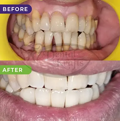 full mouth rehabilitation treatment gurgaon