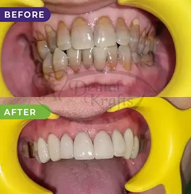 full mouth rehabilitation treatment gurgaon