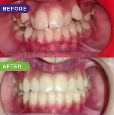 full mouth rehabilitation treatment gurgaon