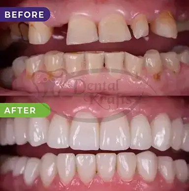 full mouth rehabilitation treatment gurgaon