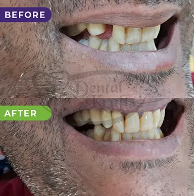 teeth implant gurgaon
