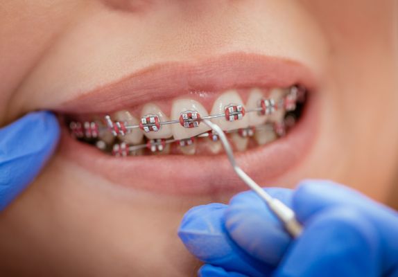 braces treatment in gurgaon