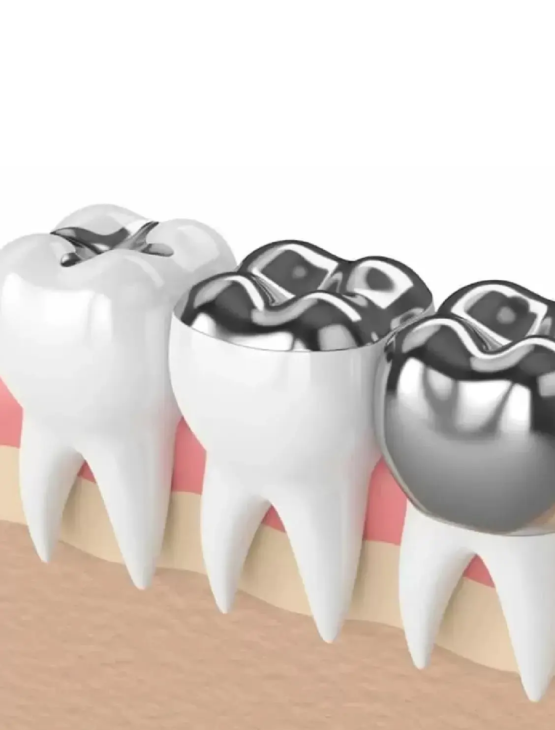 Alternatives to Dental Fillings
