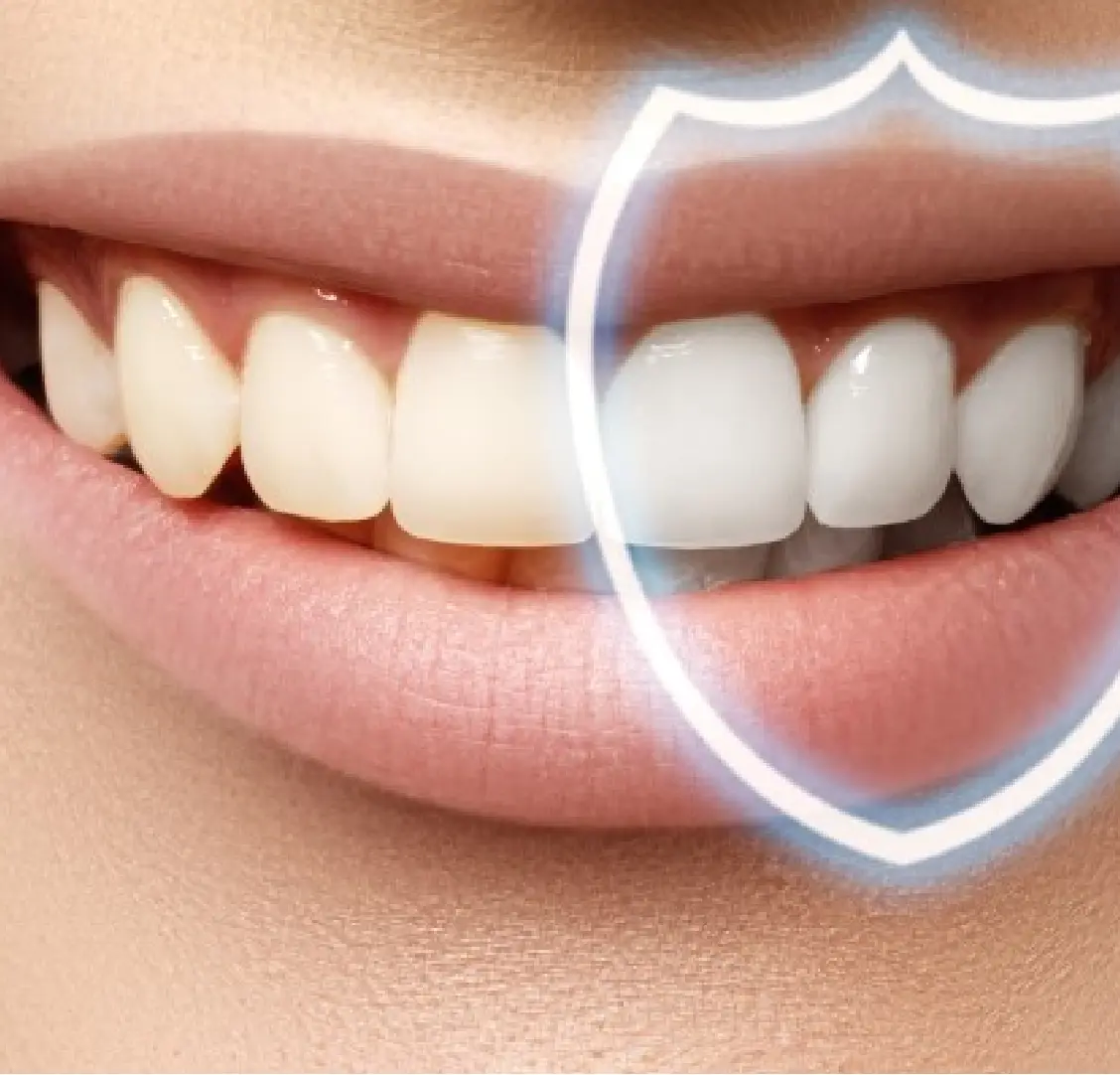 Best Teeth Whitening Treatment Gurgaon