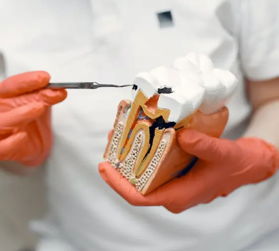 Causes of Root Canal Treatment