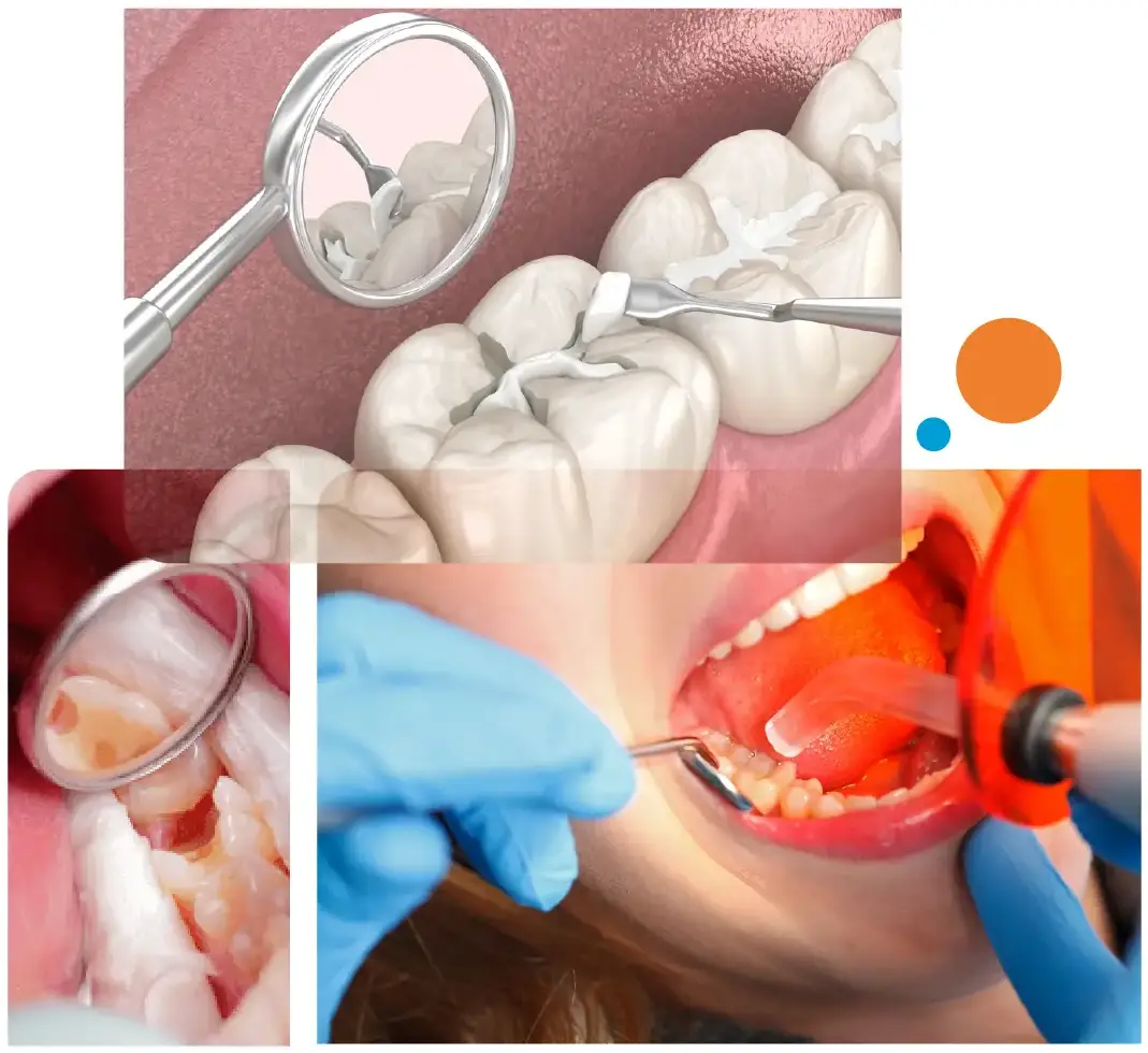 Dental Filling in Gurgaon