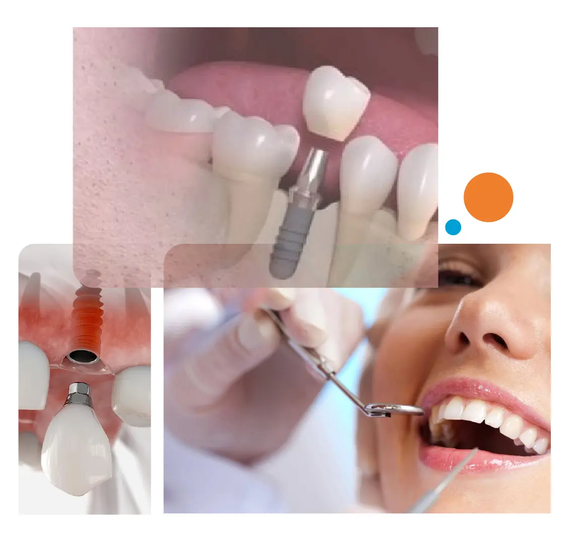 dental implants in gurgaon