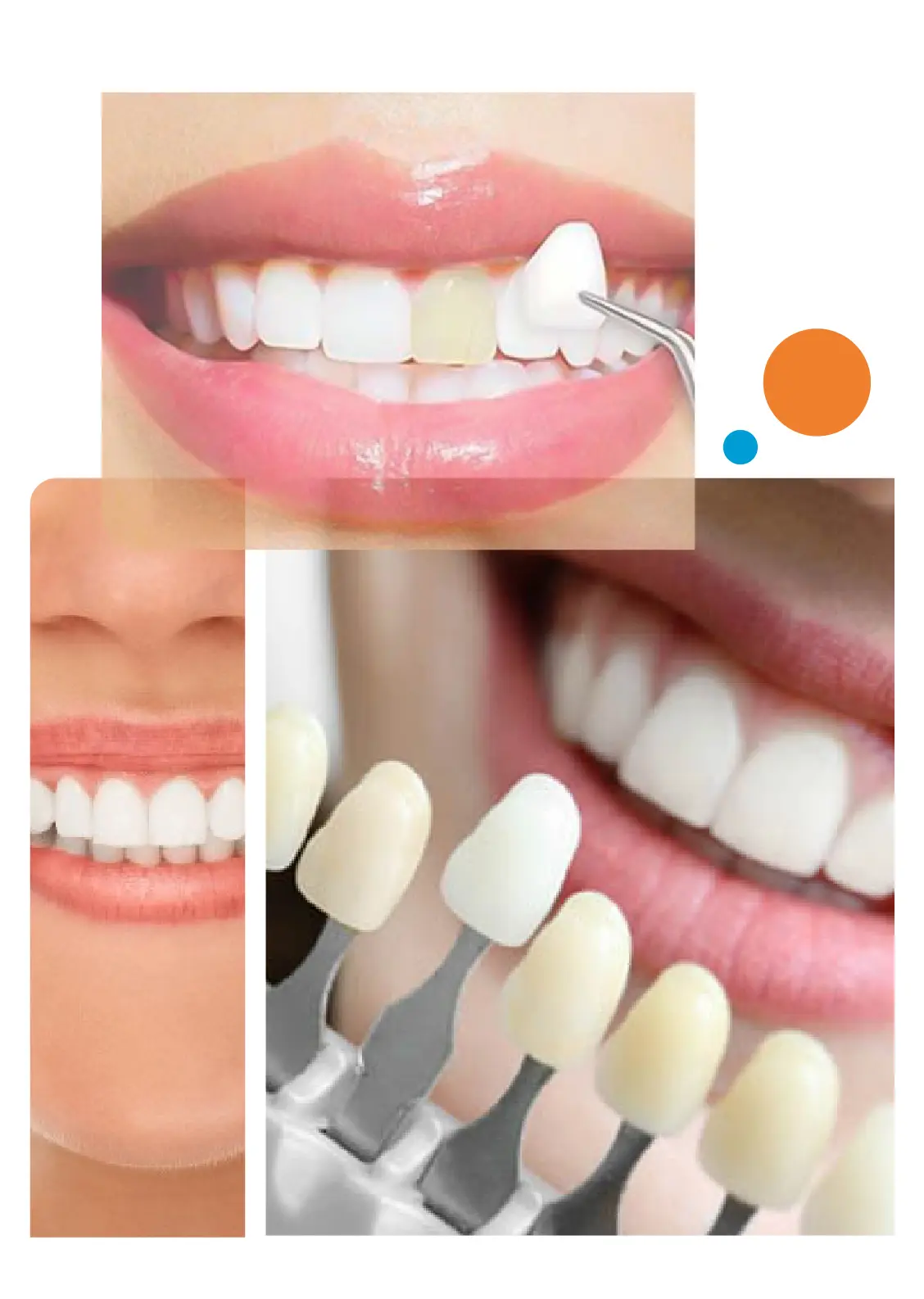 Dental Veneers In Gurgaon