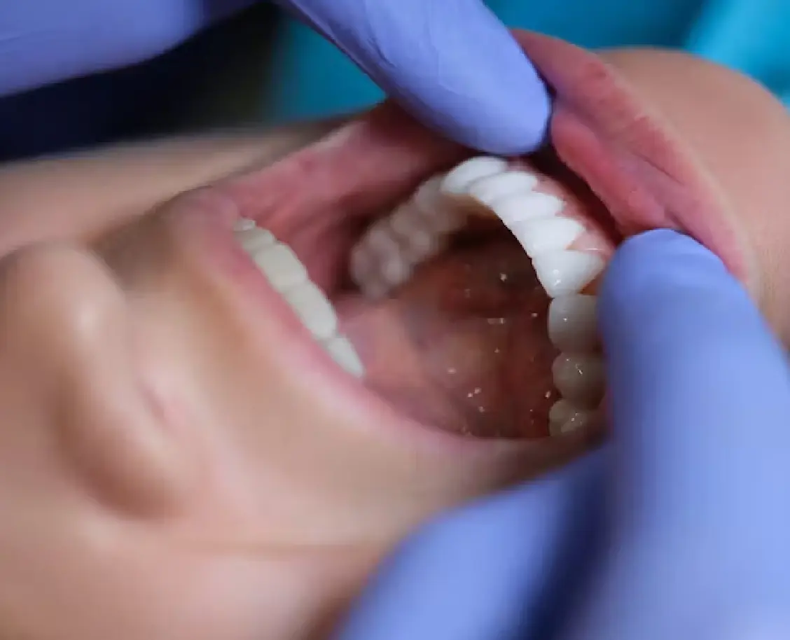 dental veneers expectations