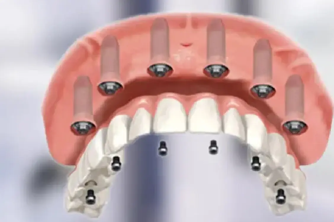 All On Four/Six Dental Implants Technique