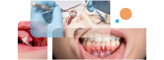 Gums Diseases Treatment In Gurgaon