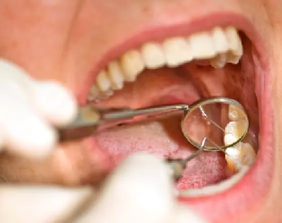 Painless Root Canal Treatment in Gurgaon