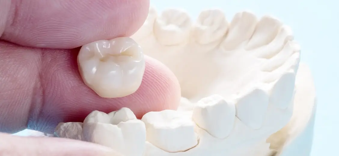 Dental Crowns Gurugram