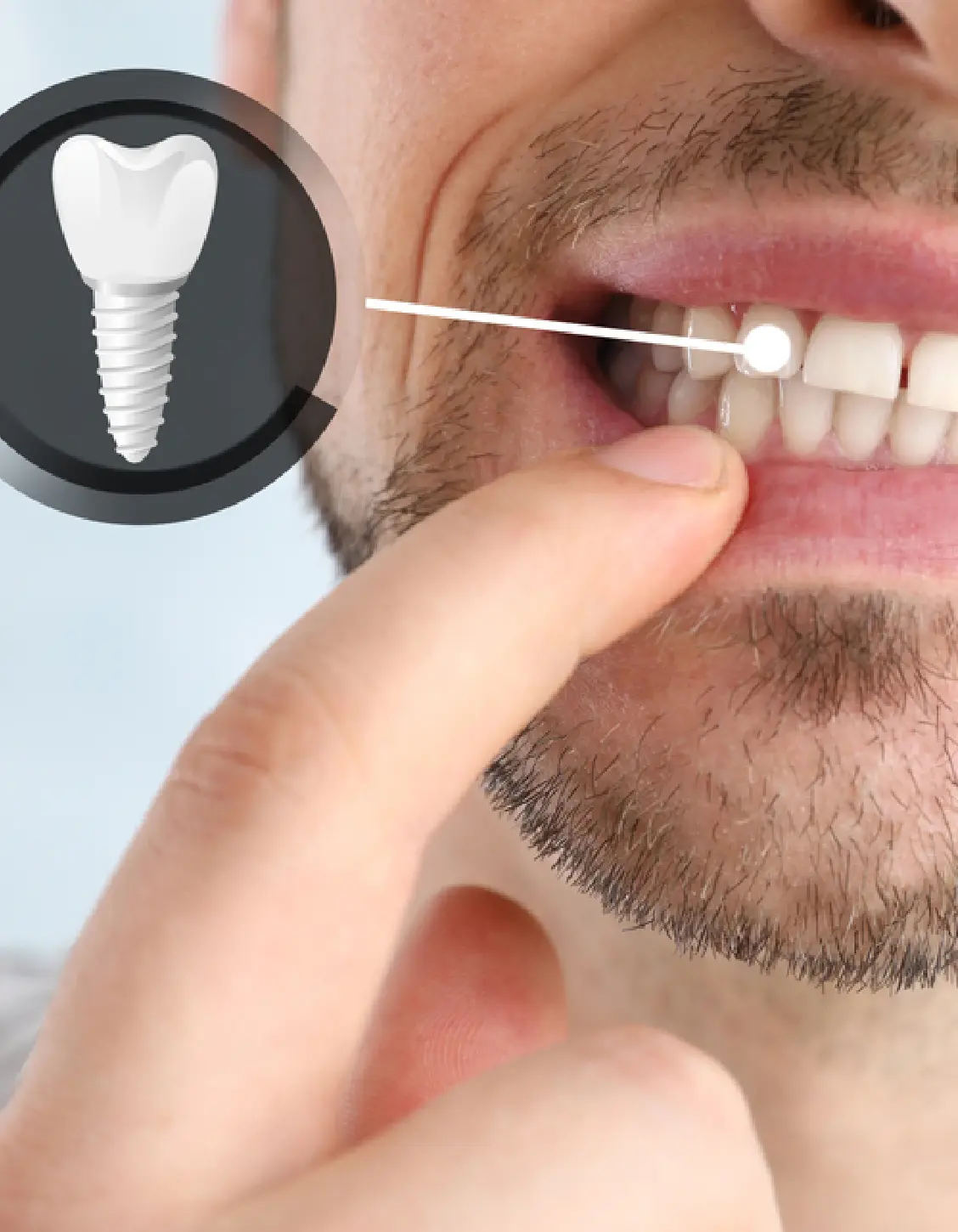 dental implants clinic gurgaon