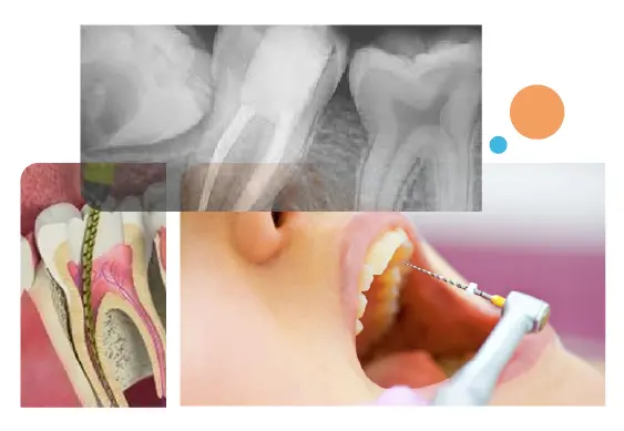 Root Canal Treatment in Gurgaon