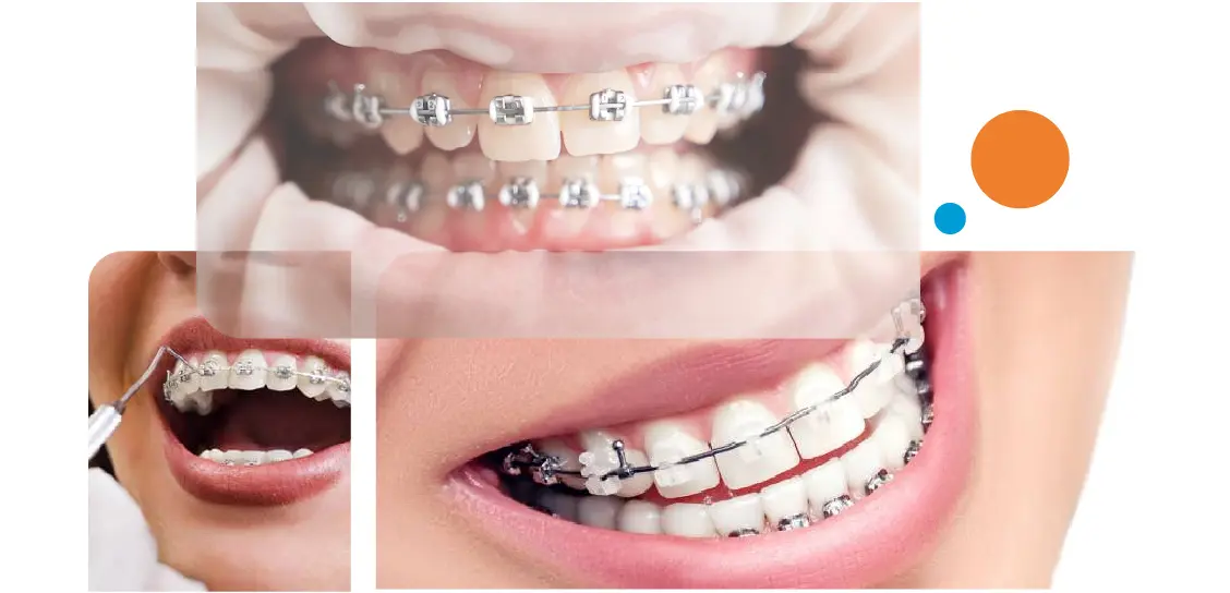 Teeth Braces In Gurgaon