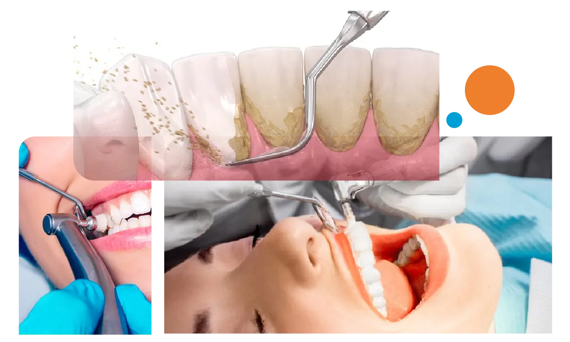 Dental Cleaning In Gurgaon