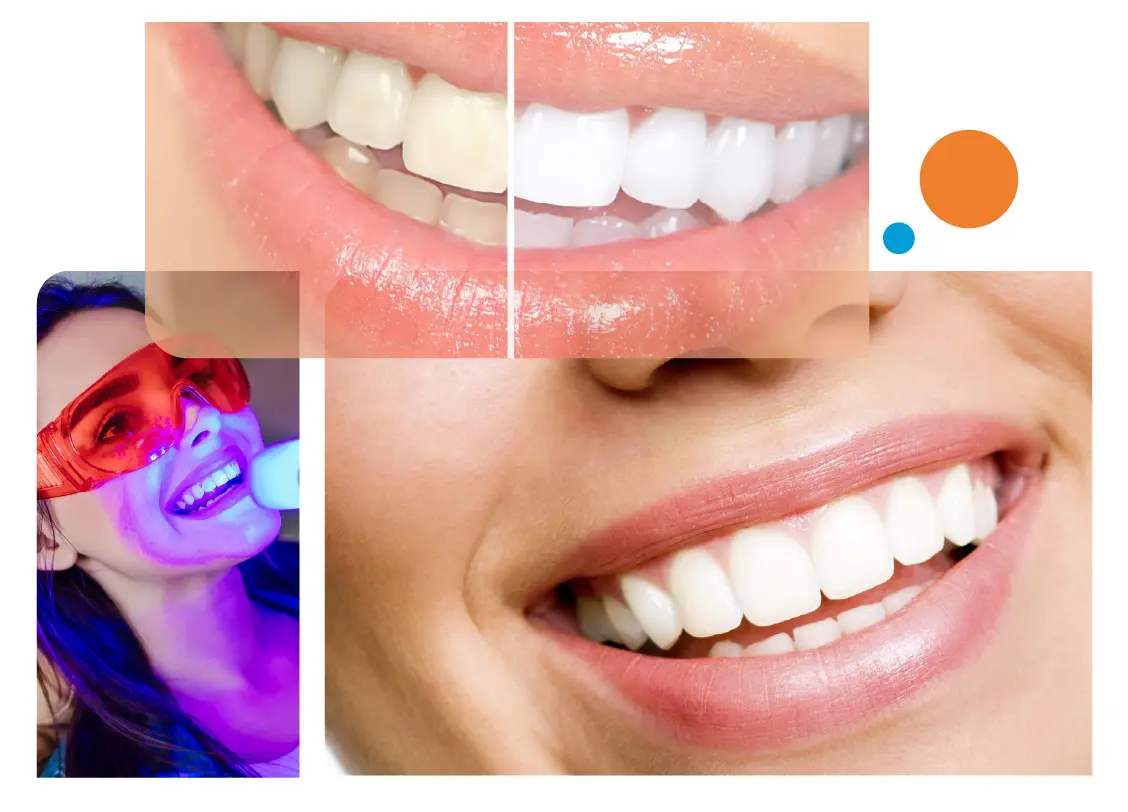 Teeth Whitening in Gurgaon
