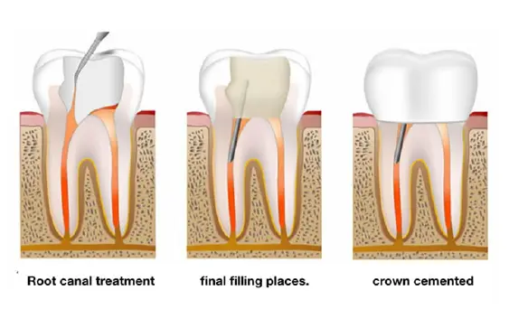 Root Canal Treatment Procedure