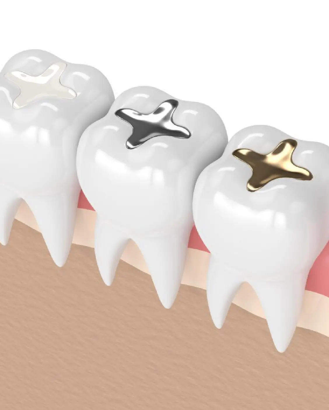 Dental Fillings Treatment