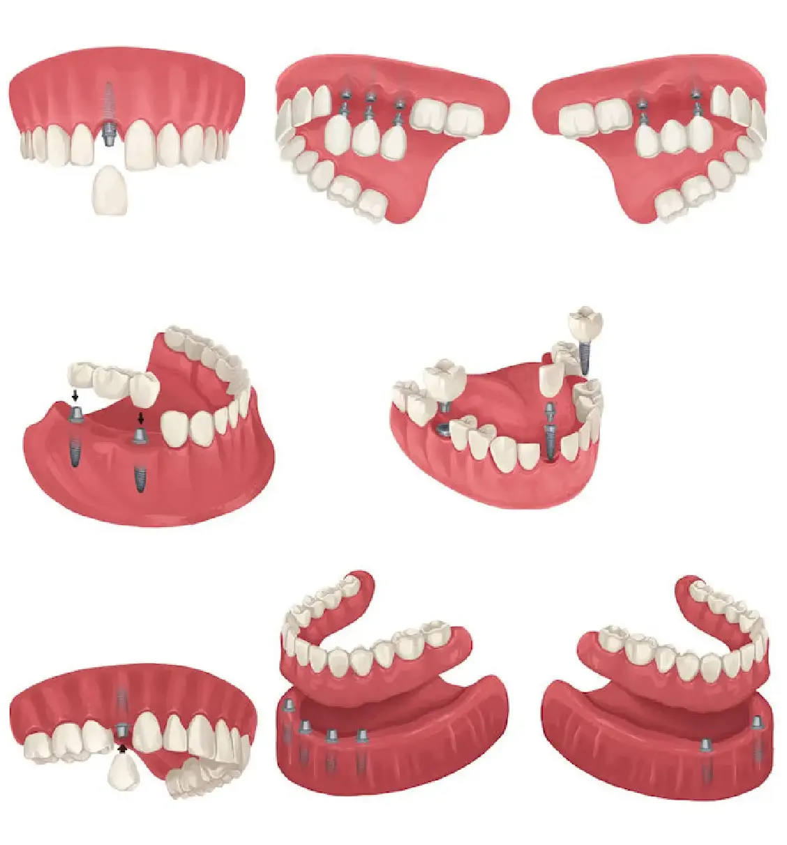 dental implants type