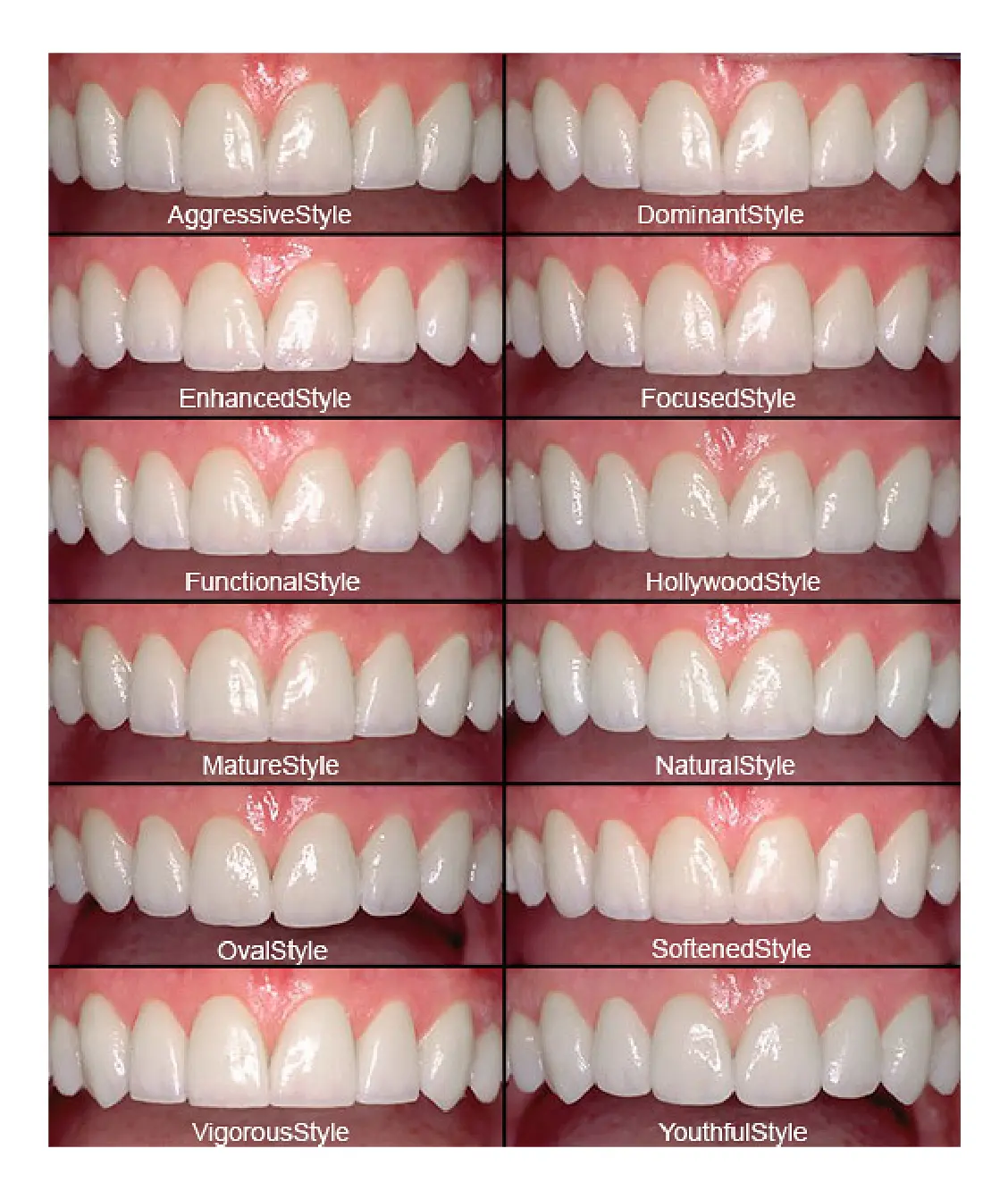 Dental Veneers Types