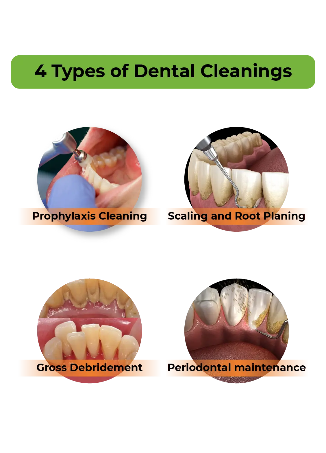 Types of teeth cleaning at Dental Krafts Gurgaon