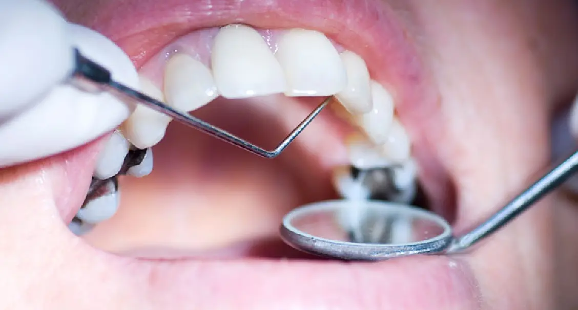 best dental filling in gurgaon
