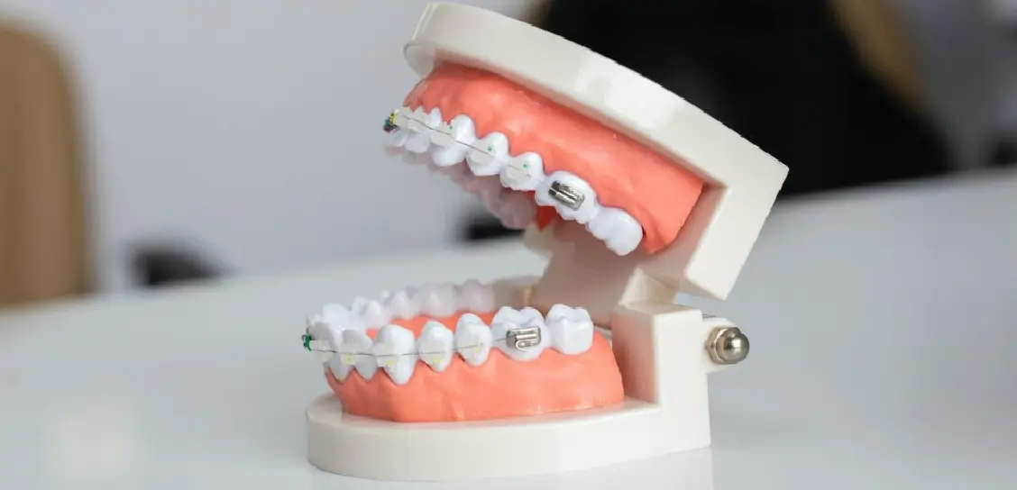 Why choose dental krafts braces
