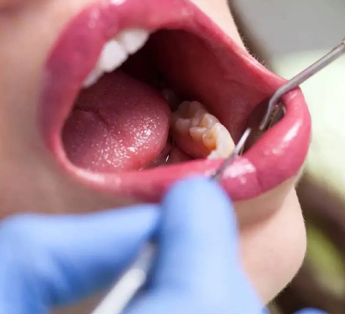 wisdom tooth extraction necessary