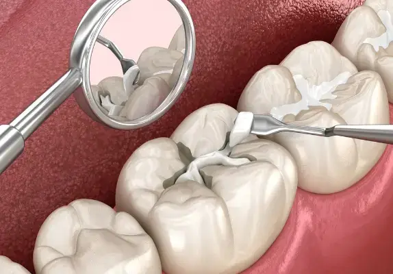 dental filling treatment in gurgaon