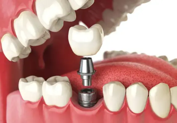 dental implants in gurgaon