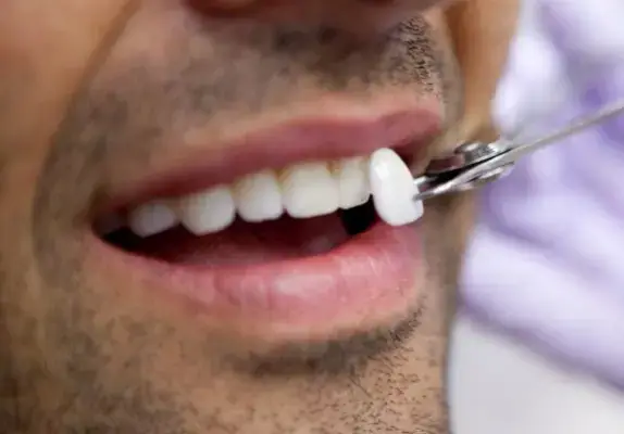 dental veneers in gurgaon